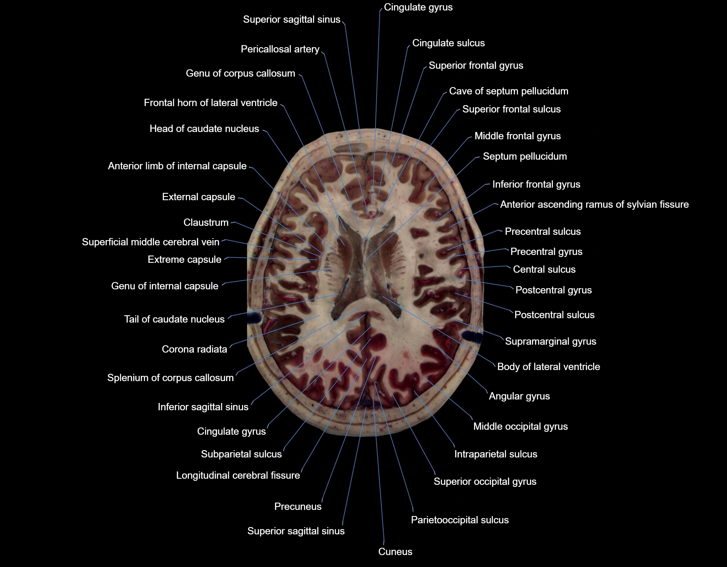 MRI Brain axial cross sectional radiology anatomy 3T image  -img-000049.webp